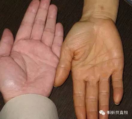 正常手掌(左)与胡萝卜素血症手掌(右)对比